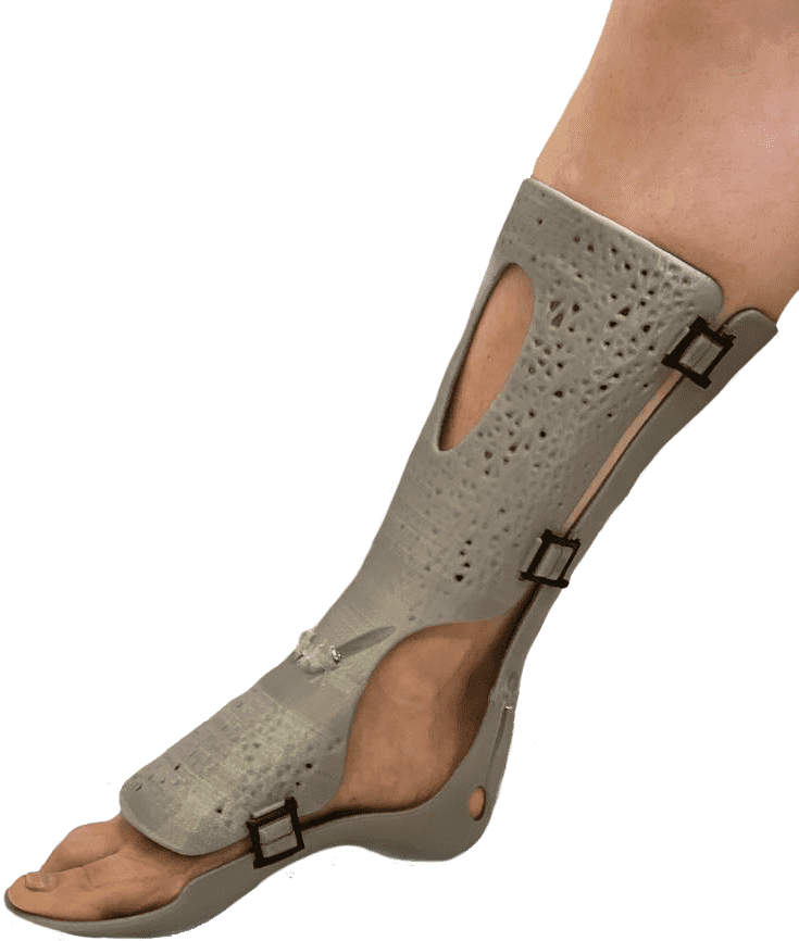 CastPrint for leg fractures